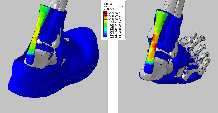 Achillessehnenruptur dissertation 04 picture