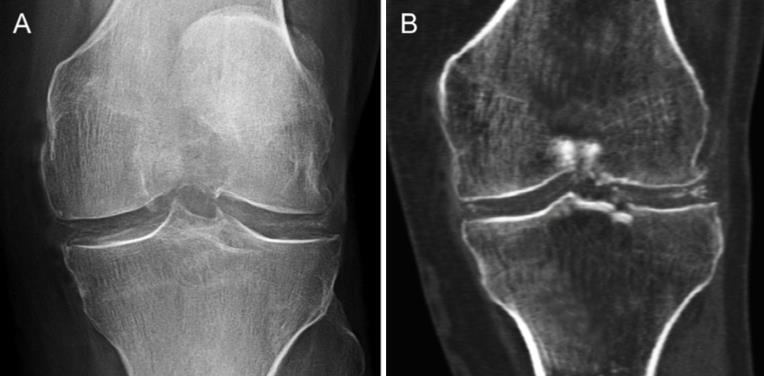 Mineralisationen in den Gelenken Ursache für die Entstehung der
